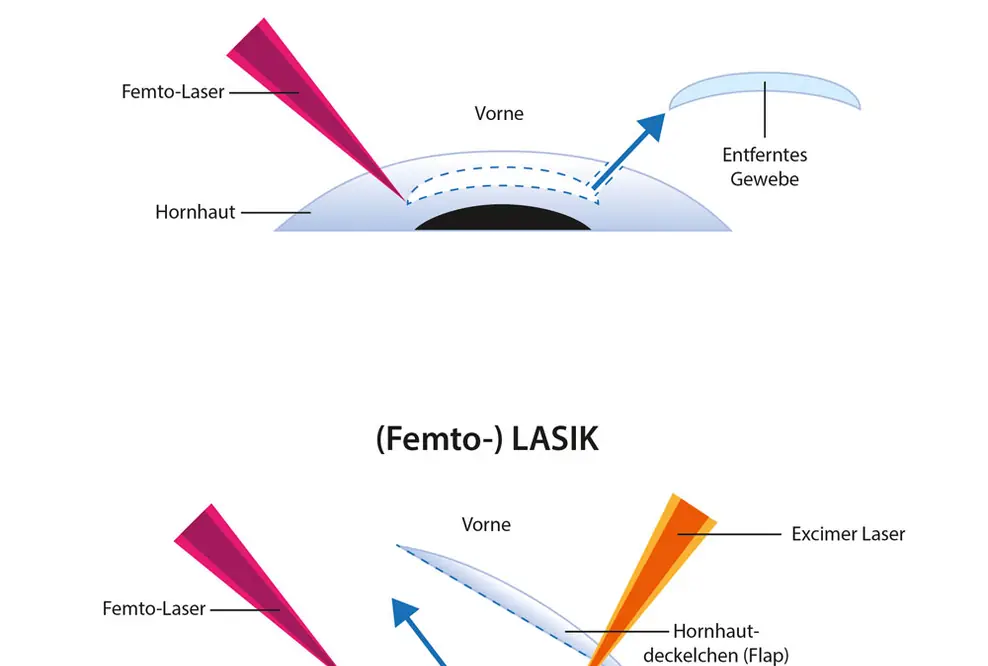 ReLEx SMILE: Portal vergleicht neue Augenlaserangebote und -preise