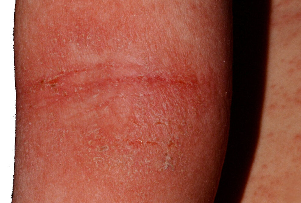 Eissauna (Kryosauna) ist ein neues erfolgreiches Mittel gegen Juckreiz bei Neurodermitis