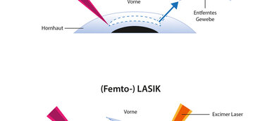 ReLEx SMILE: Portal vergleicht neue Augenlaserangebote und -preise