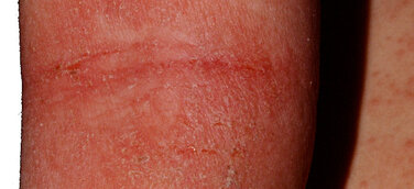 Eissauna (Kryosauna) ist ein neues erfolgreiches Mittel gegen Juckreiz bei Neurodermitis