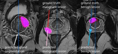 KI-Software vom Hamburger Start-up FUSE-AI hat Premiere auf der RSNA in Chicago
