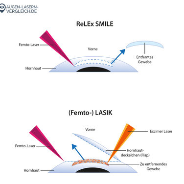 ReLEx SMILE: Portal vergleicht neue Augenlaserangebote und -preise