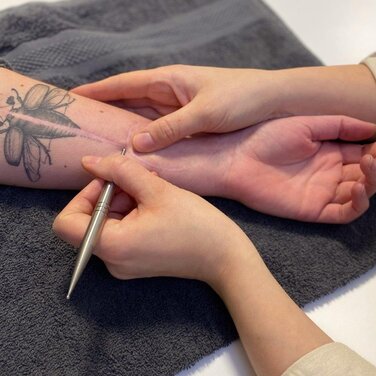 Narbenbehandlung gehört zum Arbeitsalltag von Ergotherapeut:innen; die auf Handtherapie spezialisiert sind. Ist die Narbe beispielsweise durch eine Amputation entstanden, kommen weitere zu berücksichtige Aspekte hinzu.
