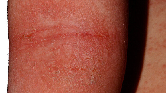 Eissauna (Kryosauna) ist ein neues erfolgreiches Mittel gegen Juckreiz bei Neurodermitis