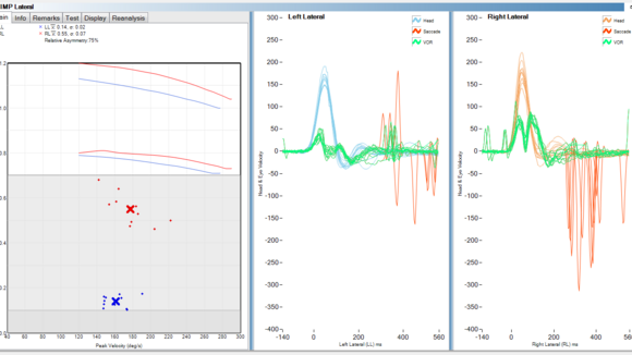 Neue Methode zur Erkennung vestibulärer Restfunktion - SHIMP